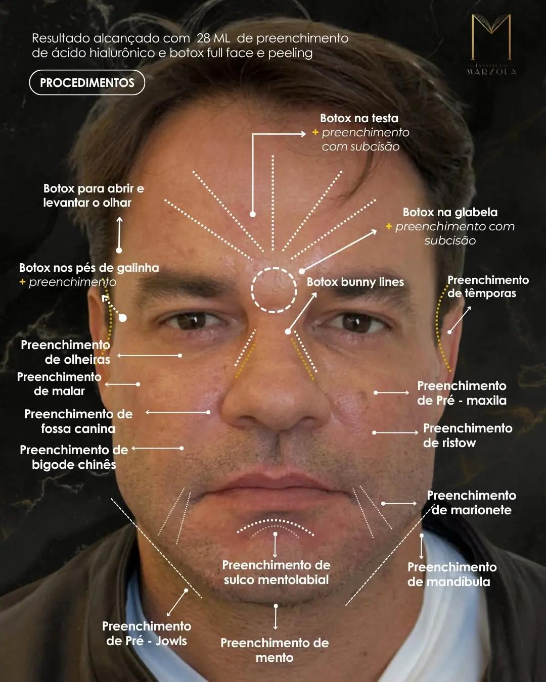 O mapa que decide a dose