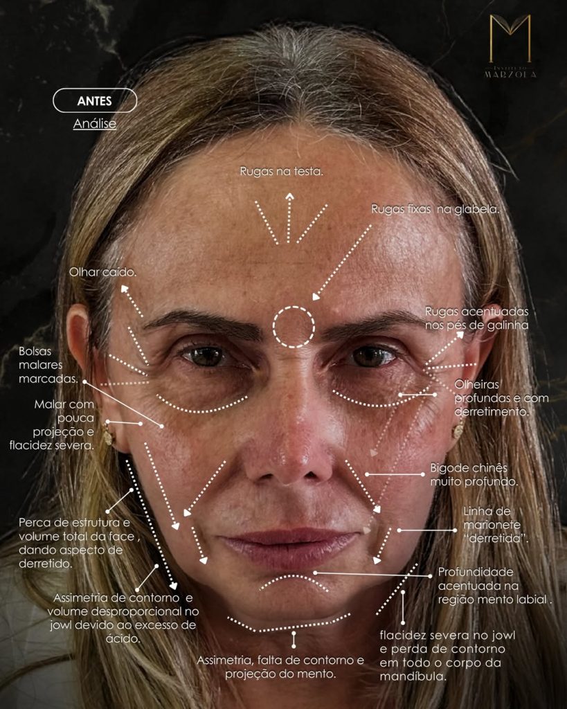 Paciente realizou o PROTOCOLO DE ESTRUTURAÇÃO FACIAL e voltou pra casa com esse resultado! Caso